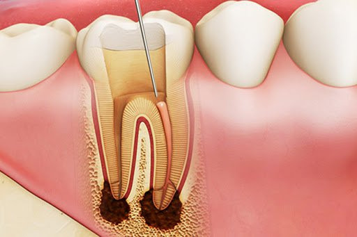 Sâu răng phải lấy tủy nhiều lần có nguy hiểm không?